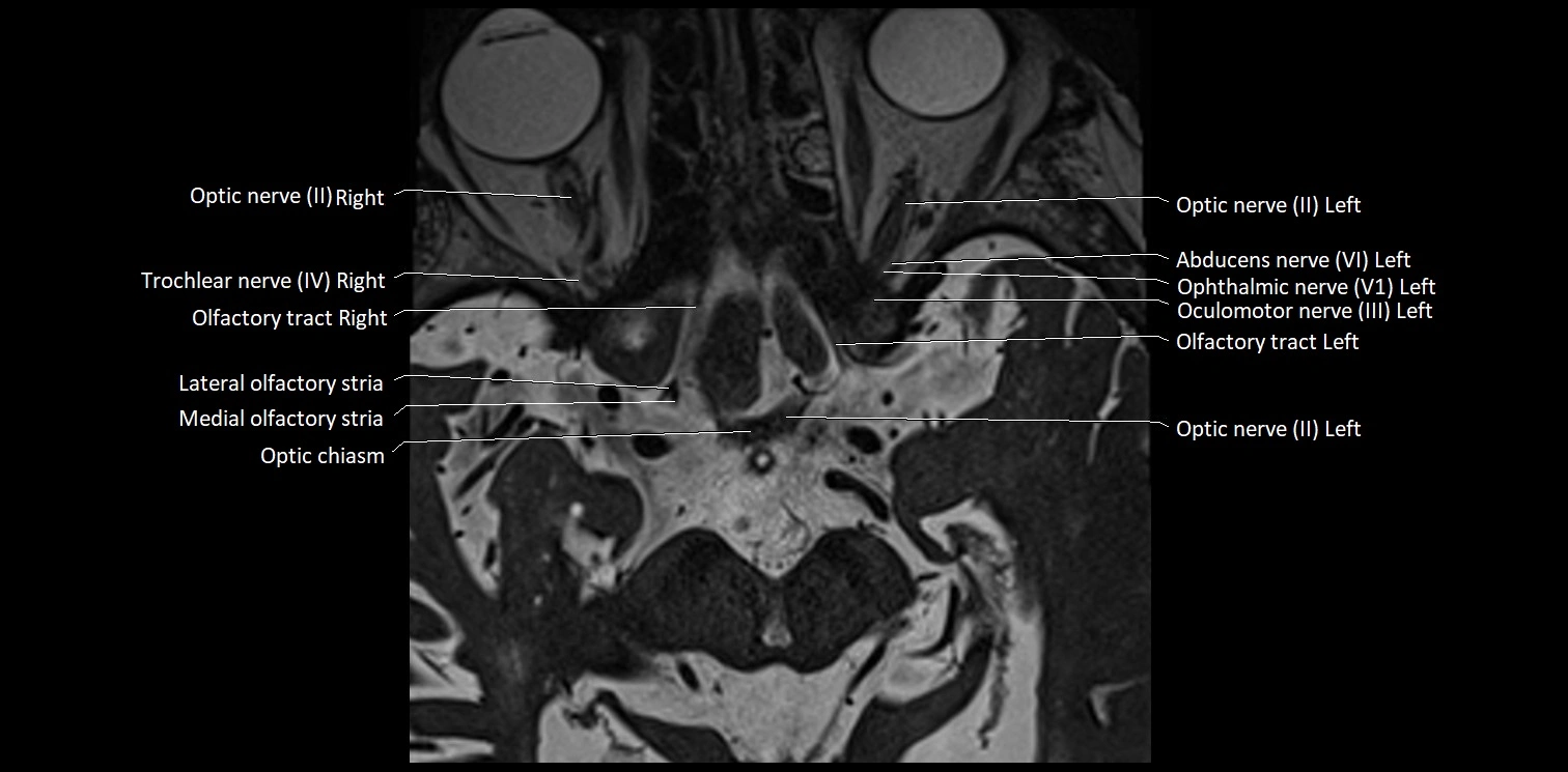 Cranial nerve anatomy axial MRI 3T image 11.webp